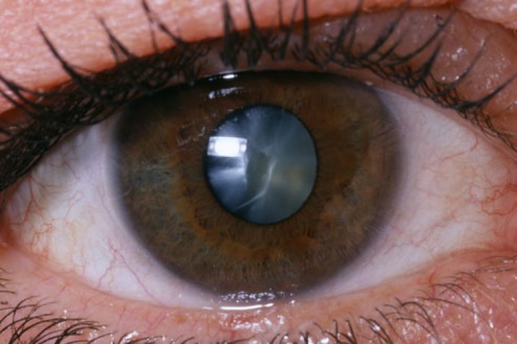 Carrots Can Prevent Cataracts Researcher Say